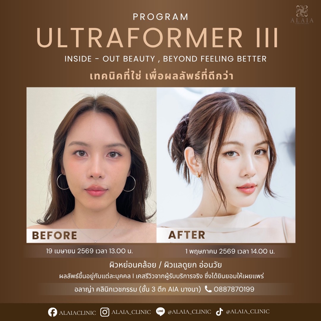 Ultraformer III Review Result 4
